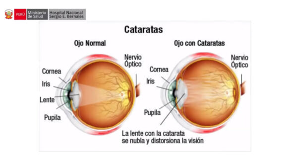 El Dr. Felipe Paredes Campos, médico oftalmólogo de nuestra institución, nos habla sobre las cataratas y nos brinda algunas recomendaciones para identificarla y prevenirla.